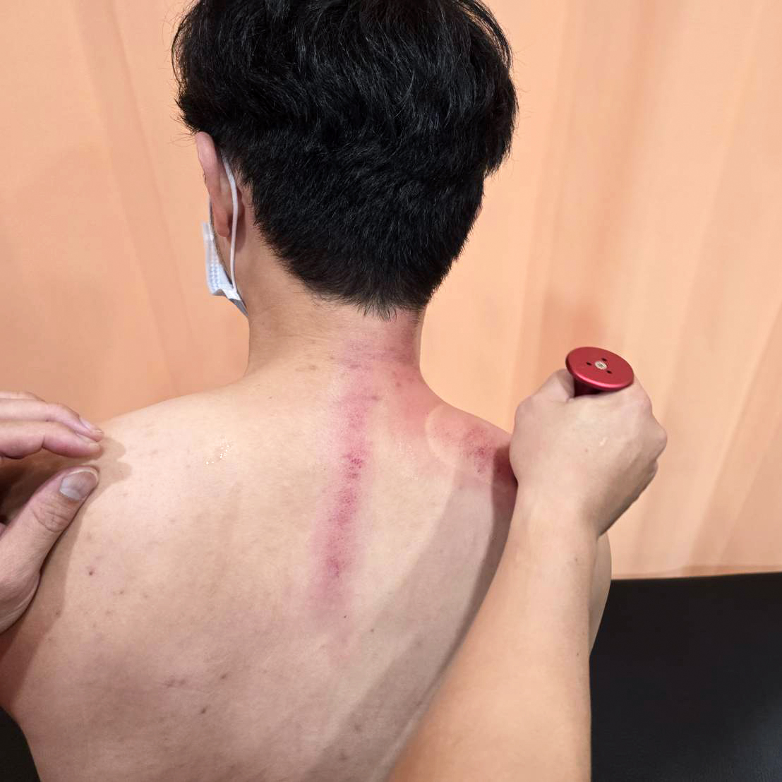 第二次治療時以溫罐刮痧