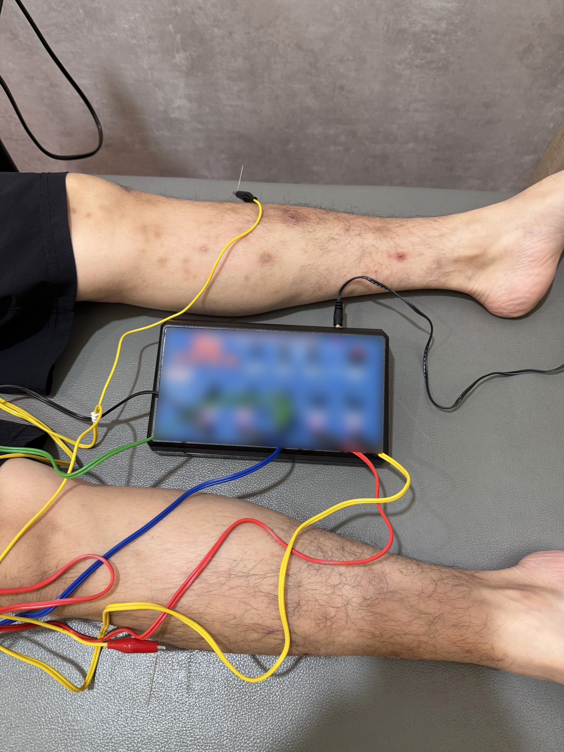 電針協助調整全身循環