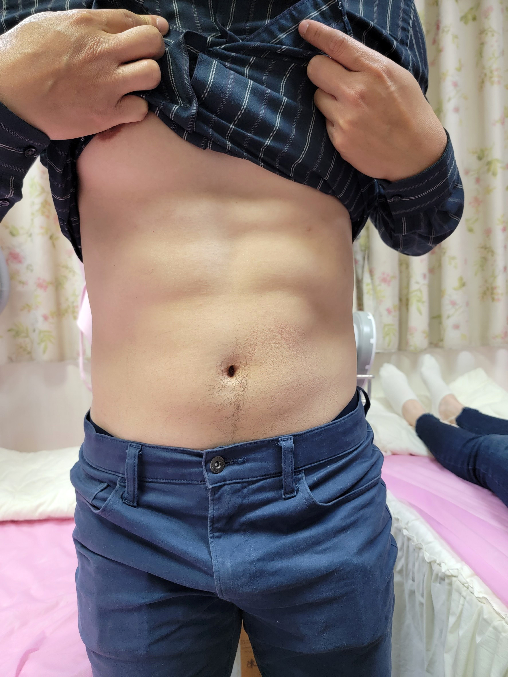 療程後腹肌線條浮現